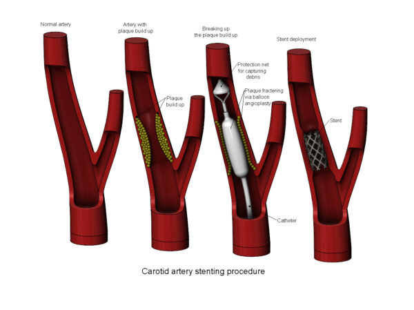 Procedimento de Implante de Stent de Artéria Carótida - Modelo 3D - Image 4