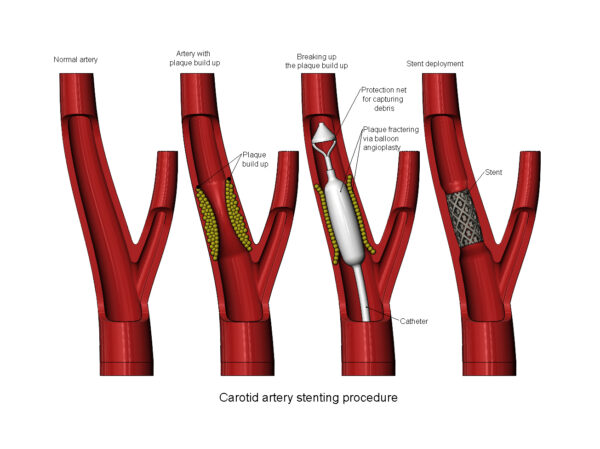 Procedimento de Implante de Stent de Artéria Carótida - Modelo 3D - Image 6