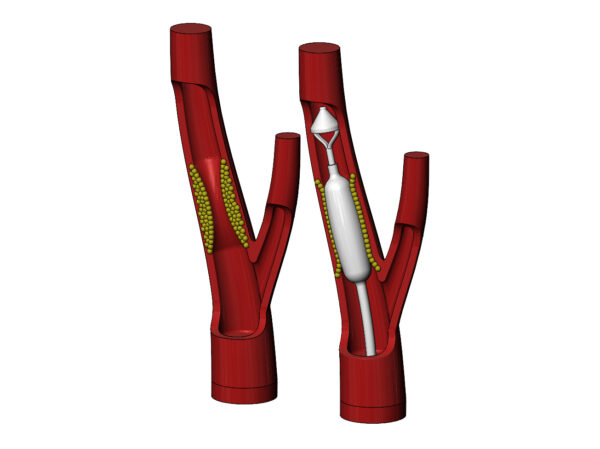 Procedimento de Implante de Stent de Artéria Carótida - Modelo 3D - Image 7