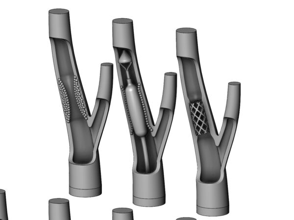 Procedimento de Implante de Stent de Artéria Carótida - Modelo 3D